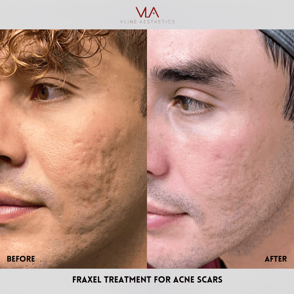 Fraxel Large Area - Skin Perfect Brothers Powered by VLA