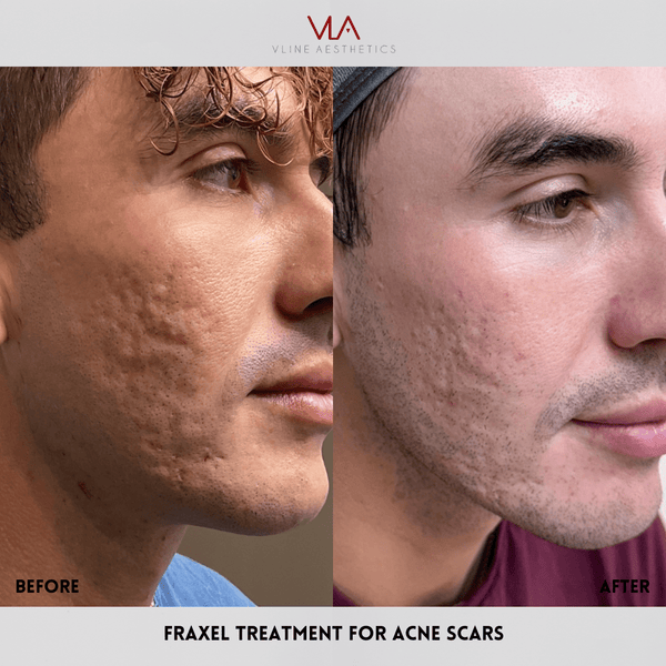 Fraxel Large Area - Skin Perfect Brothers Powered by VLA