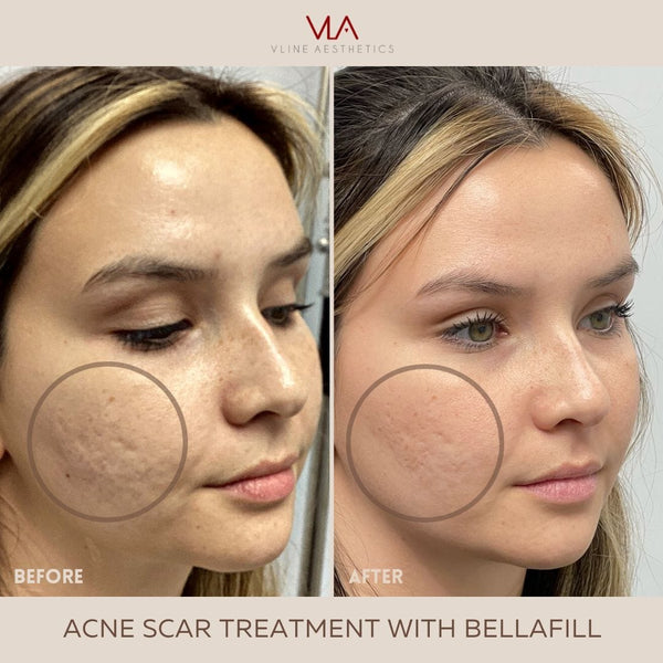 Acne Scars / 1 Bellafill - Skin Perfect Brothers Powered by VLA