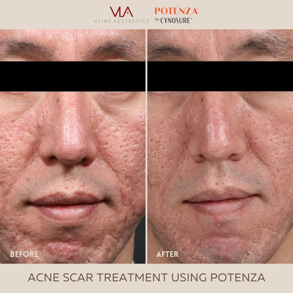 Potenza | RF Microneedling - Skin Perfect Brothers Powered by VLA