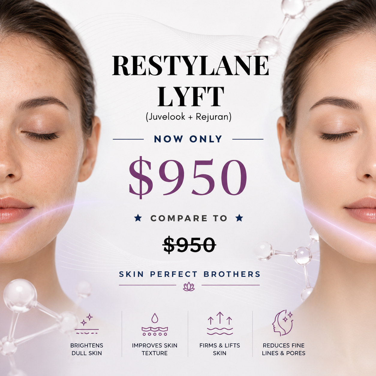 Restylane Lyft