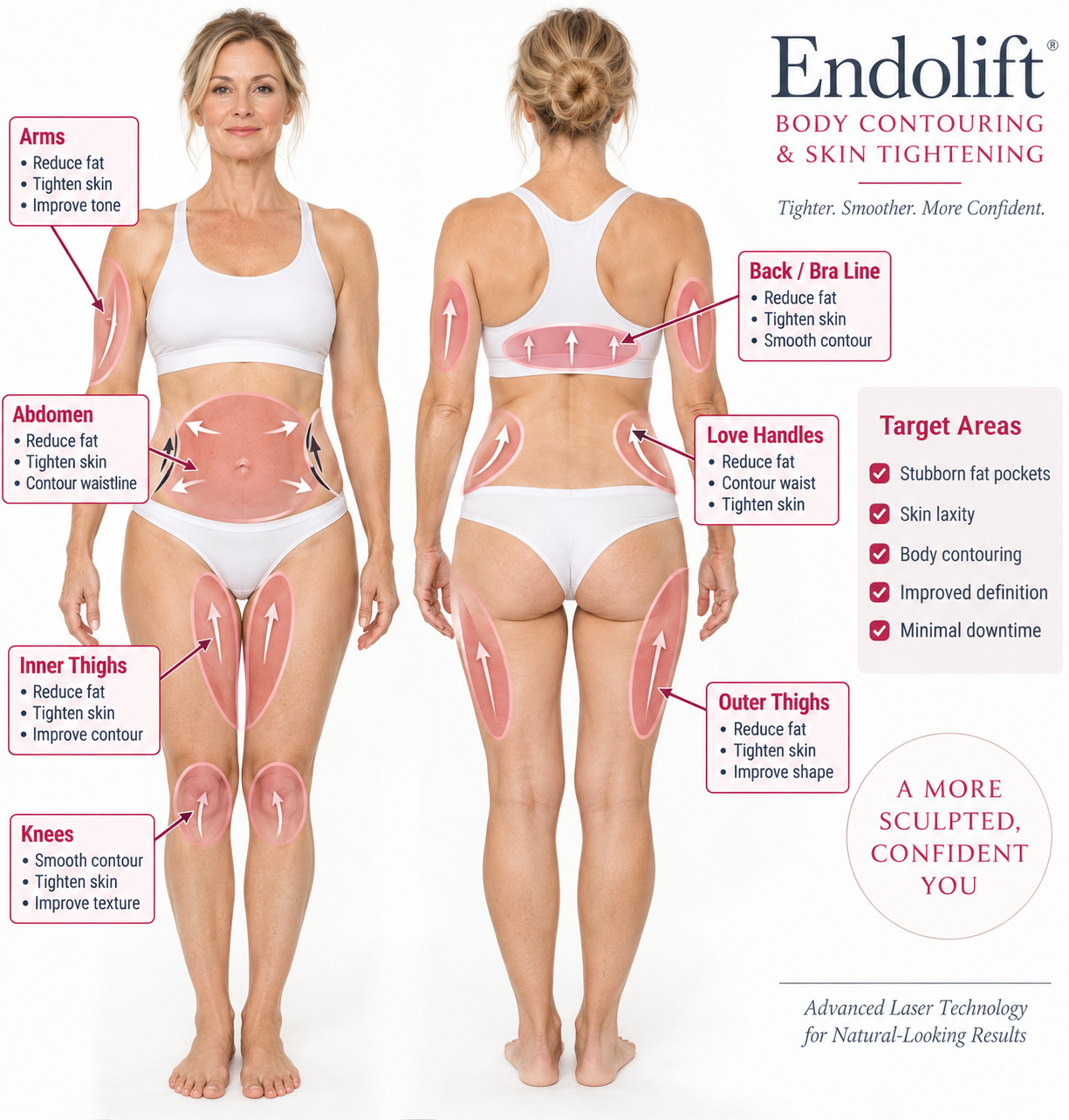 V-Lifting With EndoliftX - Skin Perfect Brothers Powered by VLA