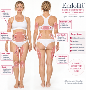 V-Lifting With EndoliftX - Skin Perfect Brothers Powered by VLA