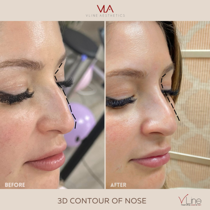 Complete Your Profile with Non-Surgical Rhinoplasty