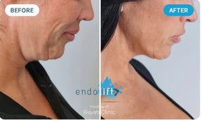 V-Lifting With EndoliftX - Skin Perfect Brothers Powered by VLA