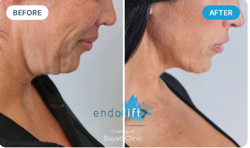 V-Lifting With EndoliftX - Skin Perfect Brothers Powered by VLA