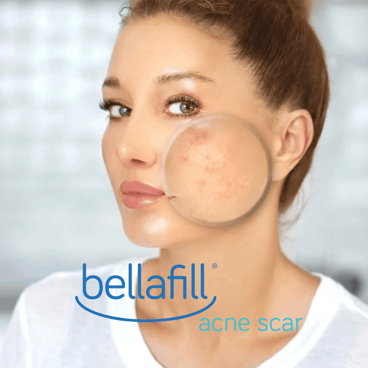 Acne Scars / 1 Bellafill - Skin Perfect Brothers Powered by VLA