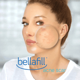 Acne Scars / 1 Bellafill - Skin Perfect Brothers Powered by VLA