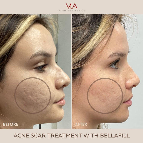 Acne Scars / 1 Bellafill - Skin Perfect Brothers Powered by VLA