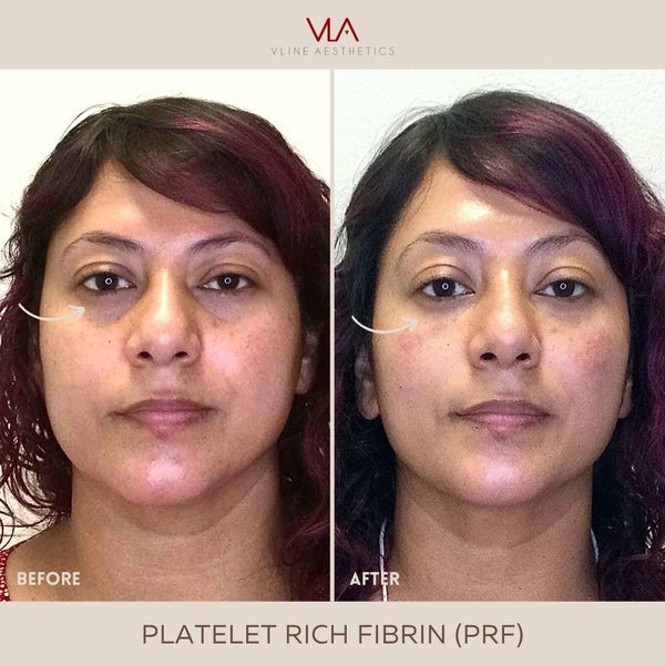 Platelet-Rich Fibrin (PRF) - Skin Perfect Brothers Powered by VLA