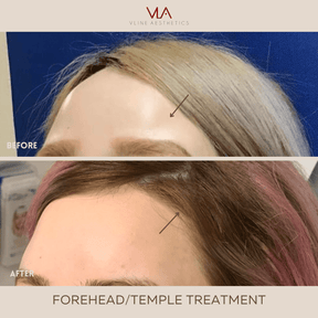 3D Forehead Contour - Skin Perfect Brothers Powered by VLA