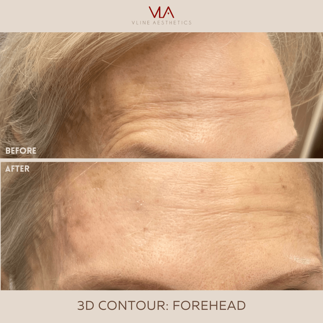 3D Forehead Contour - Skin Perfect Brothers Powered by VLA