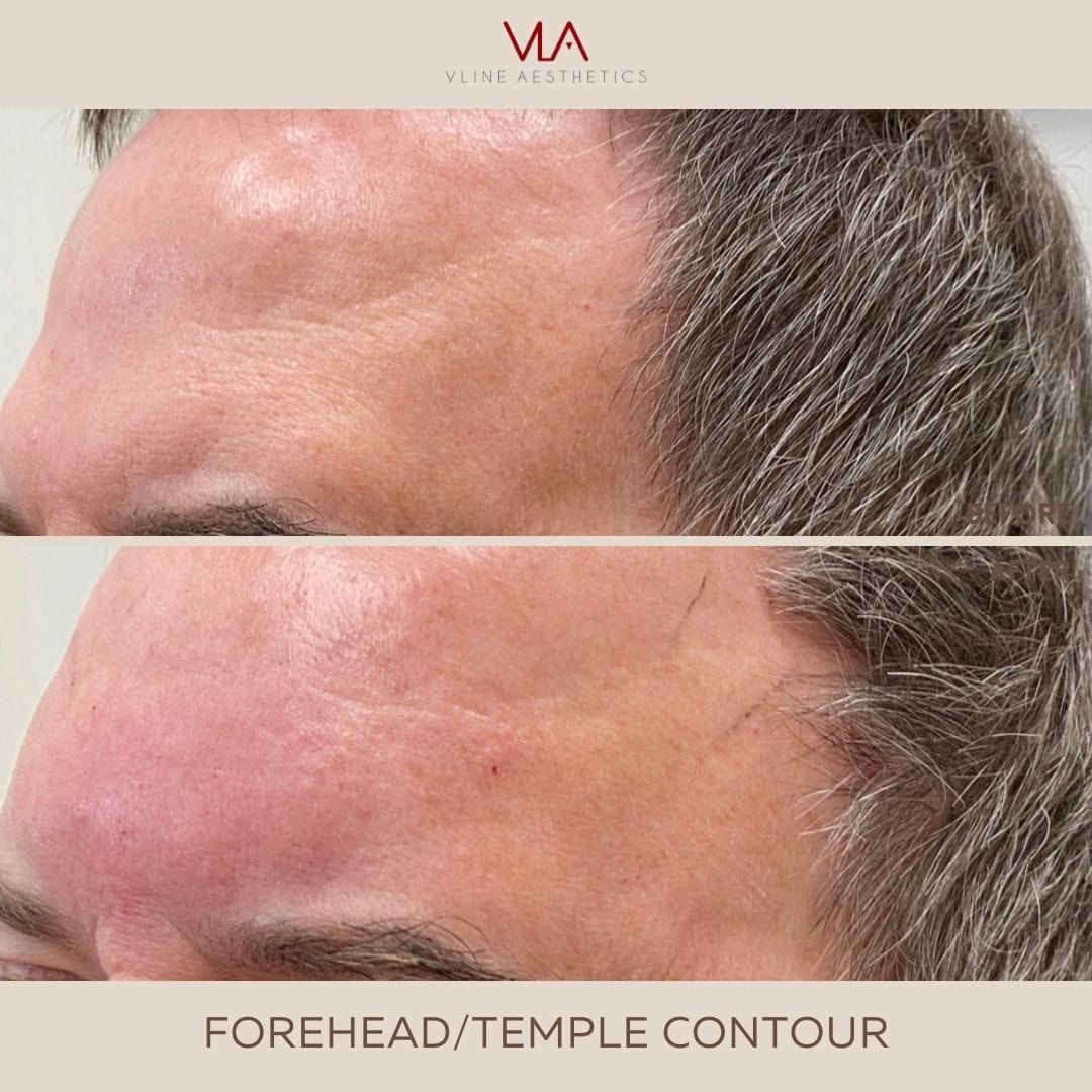 3D Forehead Contour - Skin Perfect Brothers Powered by VLA