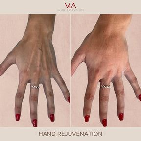 Hand Rejuvenation / 1 Radiesse - Skin Perfect Brothers Powered by VLA