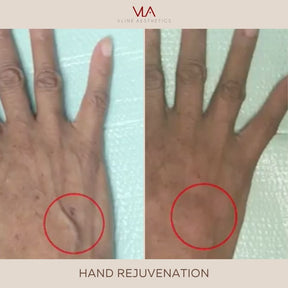Hand Rejuvenation / 1 Radiesse - Skin Perfect Brothers Powered by VLA