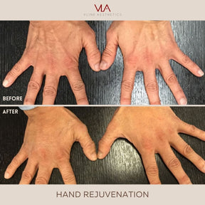 Hand Rejuvenation / 1 Radiesse - Skin Perfect Brothers Powered by VLA
