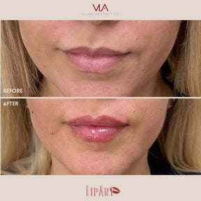 Lip Art - Skin Perfect Brothers Powered by VLA