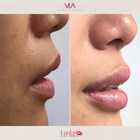 Lip Art - Skin Perfect Brothers Powered by VLA