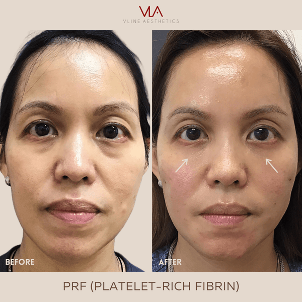 Platelet-Rich Fibrin (PRF) - Skin Perfect Brothers Powered by VLA