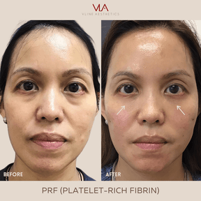 Platelet-Rich Fibrin (PRF) - Skin Perfect Brothers Powered by VLA