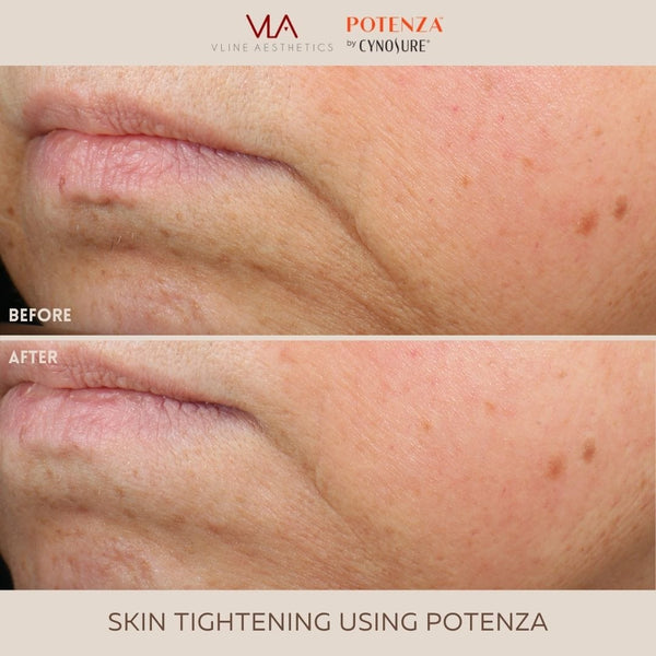 Potenza | RF Microneedling - Skin Perfect Brothers Powered by VLA