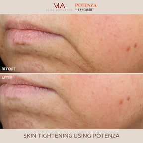 Potenza | RF Microneedling - Skin Perfect Brothers Powered by VLA