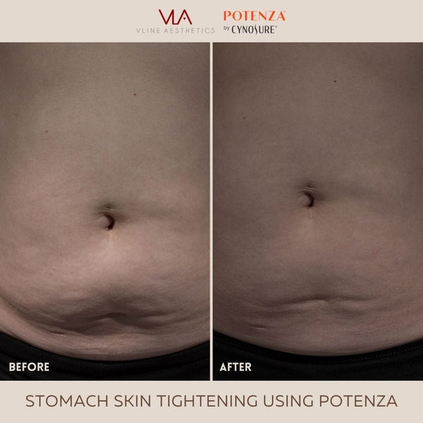Potenza | RF Microneedling - Skin Perfect Brothers Powered by VLA