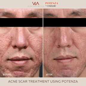 Potenza | RF Microneedling - Skin Perfect Brothers Powered by VLA