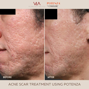 Potenza | RF Microneedling - Skin Perfect Brothers Powered by VLA