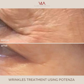 Potenza | RF Microneedling - Skin Perfect Brothers Powered by VLA
