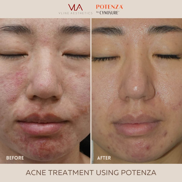 Potenza | RF Microneedling - Skin Perfect Brothers Powered by VLA