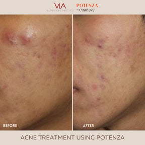 Potenza | RF Microneedling - Skin Perfect Brothers Powered by VLA