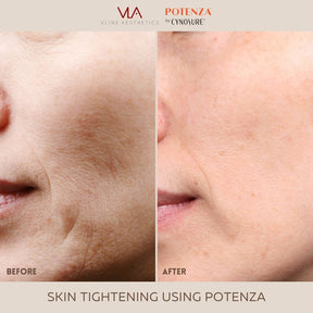 Potenza | RF Microneedling - Skin Perfect Brothers Powered by VLA