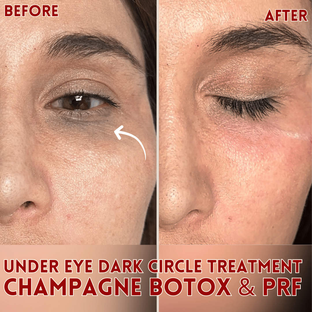 Champagne Botox - Skin Perfect Brothers Powered by VLA