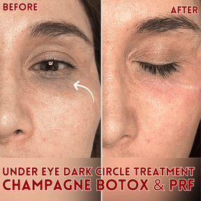 Champagne Botox - Skin Perfect Brothers Powered by VLA