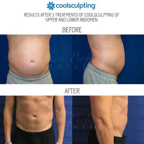 Coolsculpting | Body Sculpting - Skin Perfect Brothers Powered by VLA