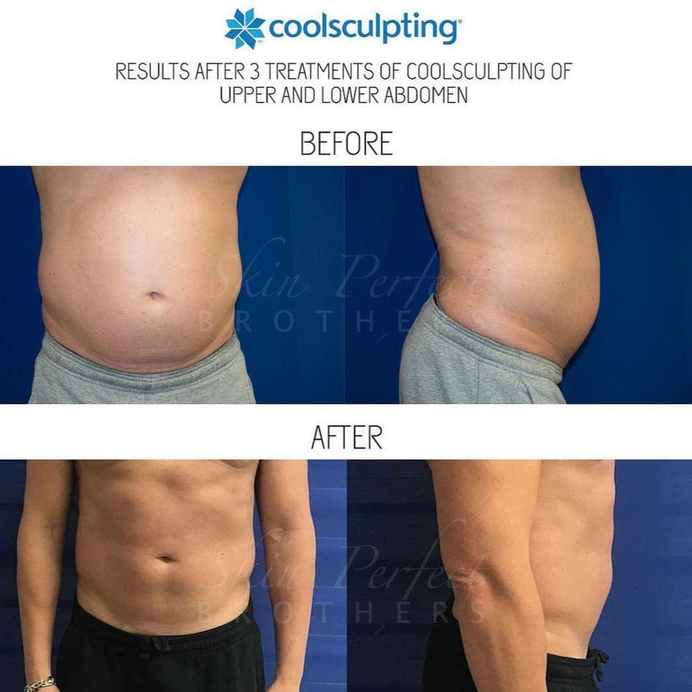Coolsculpting | Body Sculpting - Skin Perfect Brothers Powered by VLA