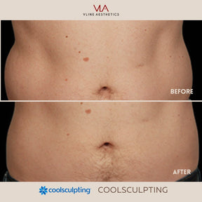 Coolsculpting | Body Sculpting - Skin Perfect Brothers Powered by VLA