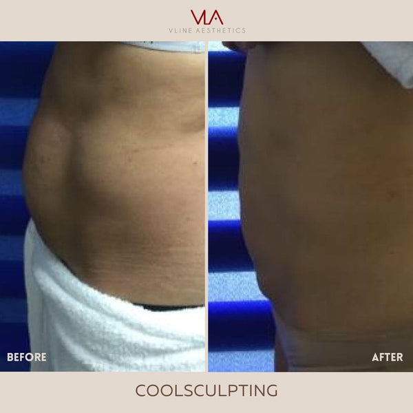 Coolsculpting | Body Sculpting - Skin Perfect Brothers Powered by VLA