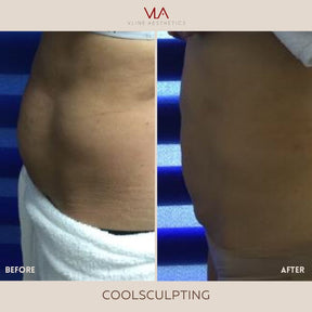 Coolsculpting | Body Sculpting - Skin Perfect Brothers Powered by VLA