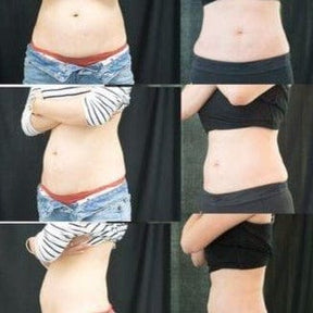 Coolsculpting | Body Sculpting - Skin Perfect Brothers Powered by VLA