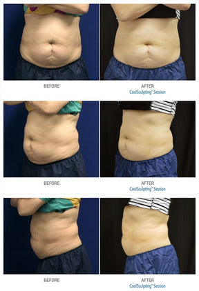 Coolsculpting | Body Sculpting - Skin Perfect Brothers Powered by VLA