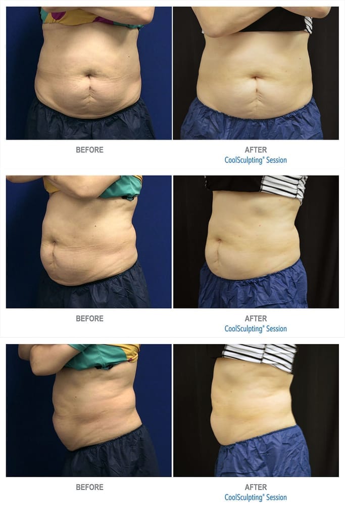 Coolsculpting | Body Sculpting - Skin Perfect Brothers Powered by VLA