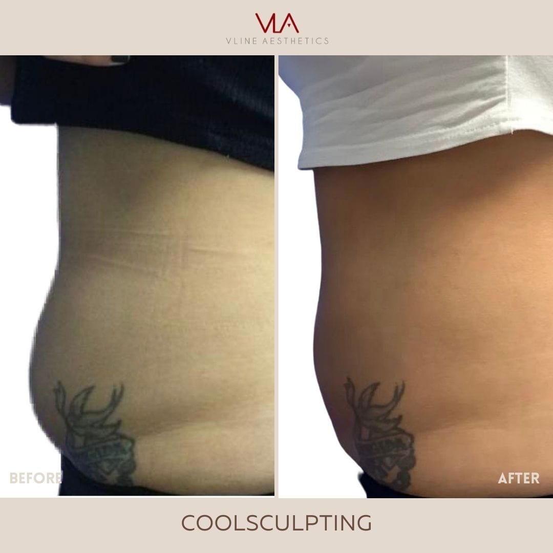 Coolsculpting | Body Sculpting - Skin Perfect Brothers Powered by VLA
