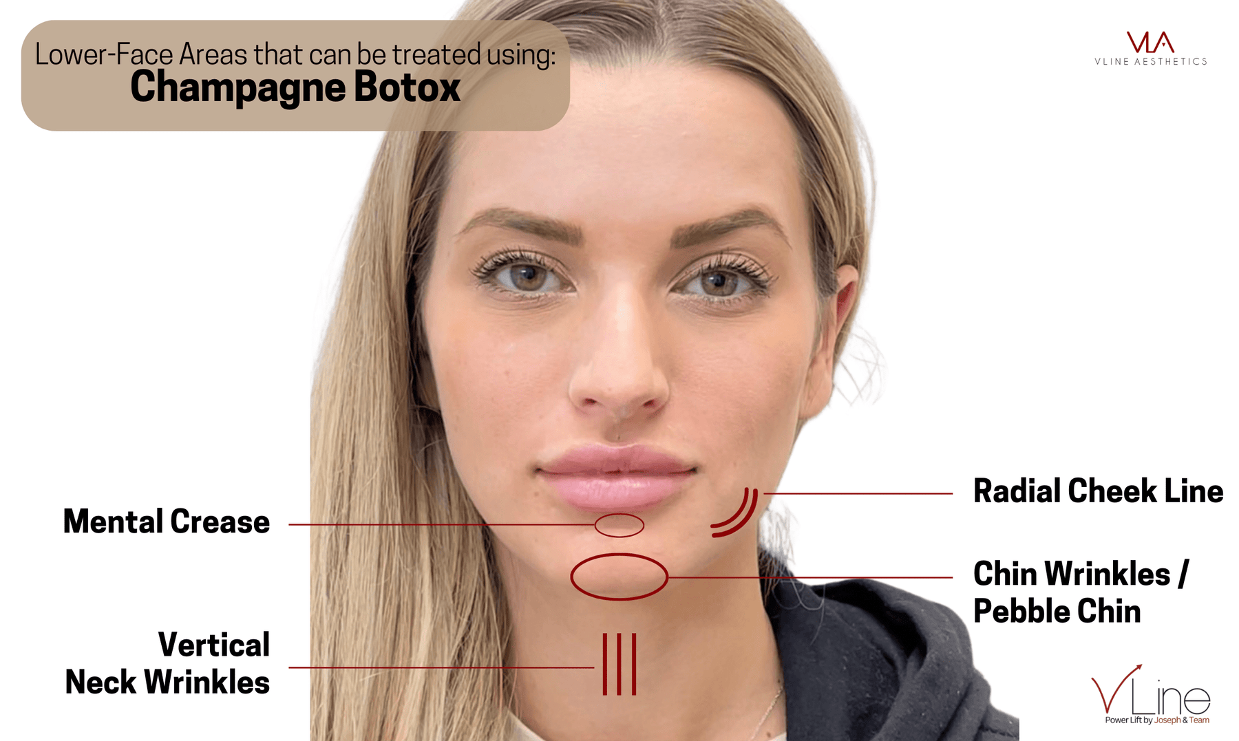 Champagne Botox - Skin Perfect Brothers Powered by VLA