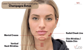 Champagne Botox - Skin Perfect Brothers Powered by VLA