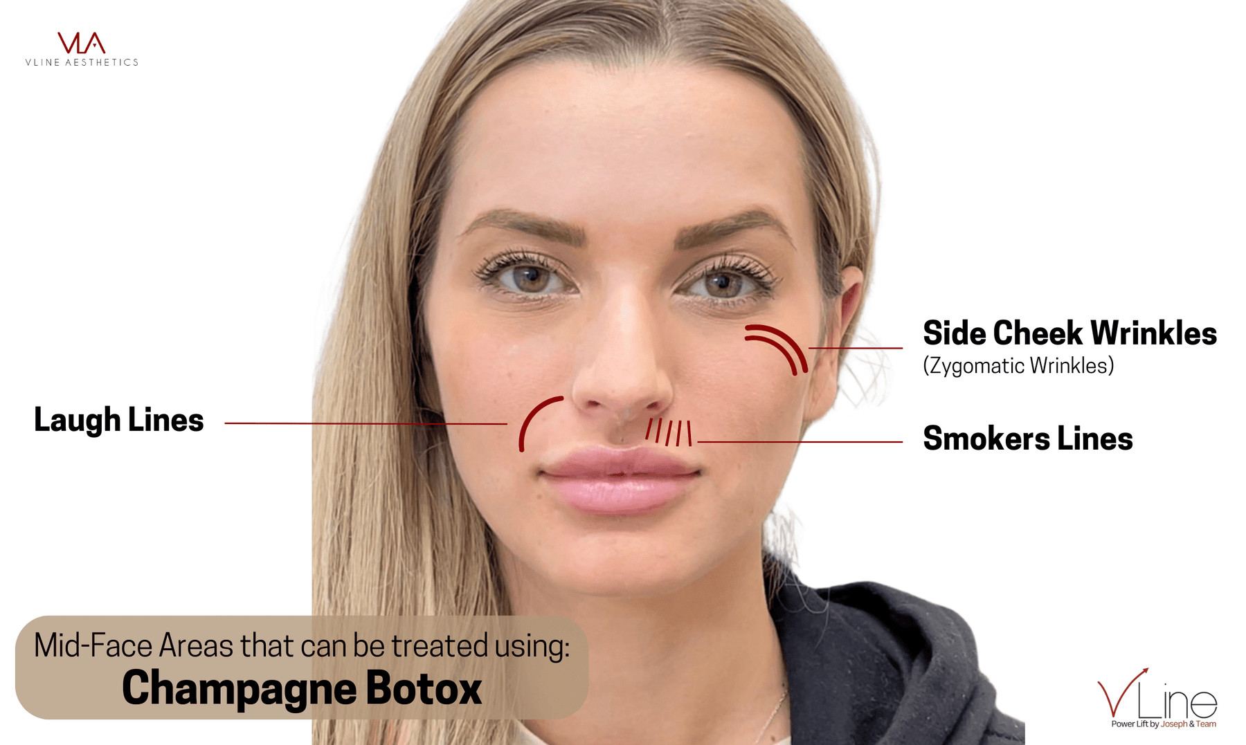 Champagne Botox - Skin Perfect Brothers Powered by VLA