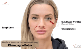Champagne Botox - Skin Perfect Brothers Powered by VLA