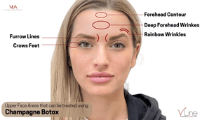 Champagne Botox - Skin Perfect Brothers Powered by VLA