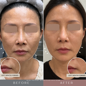 V-Lifting With EndoliftX - Skin Perfect Brothers Powered by VLA